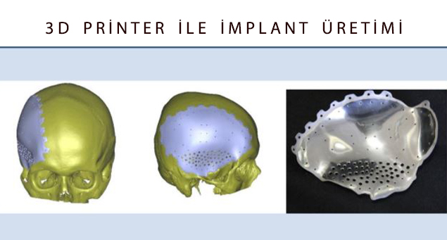 İmplant Üretimi